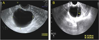 Benign Brenner tumor of the ovary: two-dimensional and contrast-enhanced ultrasound features—a retrospective study from a single center